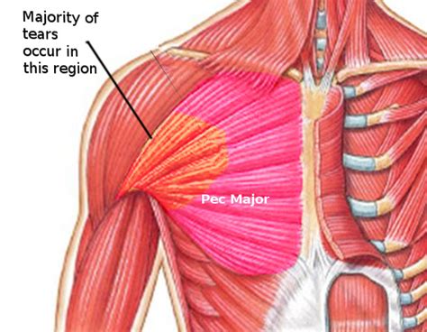 pectoralis tear examples